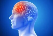 Calor pode aumentar risco de casos de AVC, alerta médico