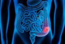 Mortes por câncer colorretal devem aumentar quase 3 vezes até 2030