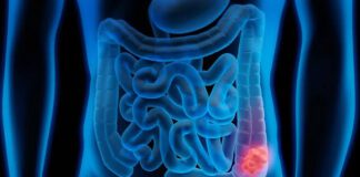 Mortes por câncer colorretal devem aumentar quase 3 vezes até 2030